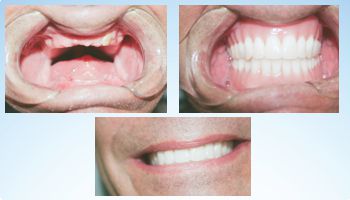 DENTADURAS TOTALES