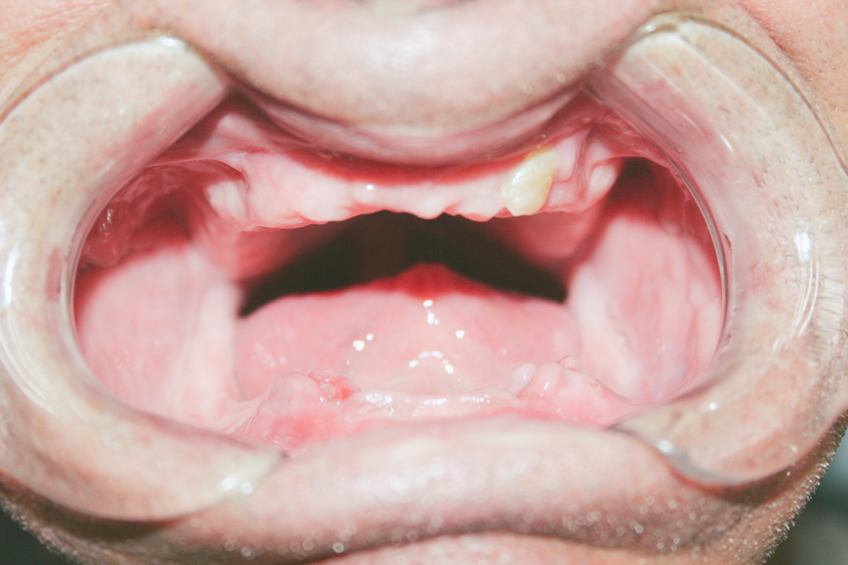 Dentaduras Totales
