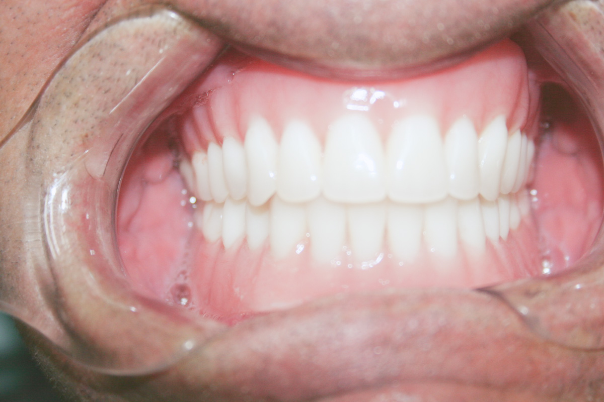Dentaduras Totales