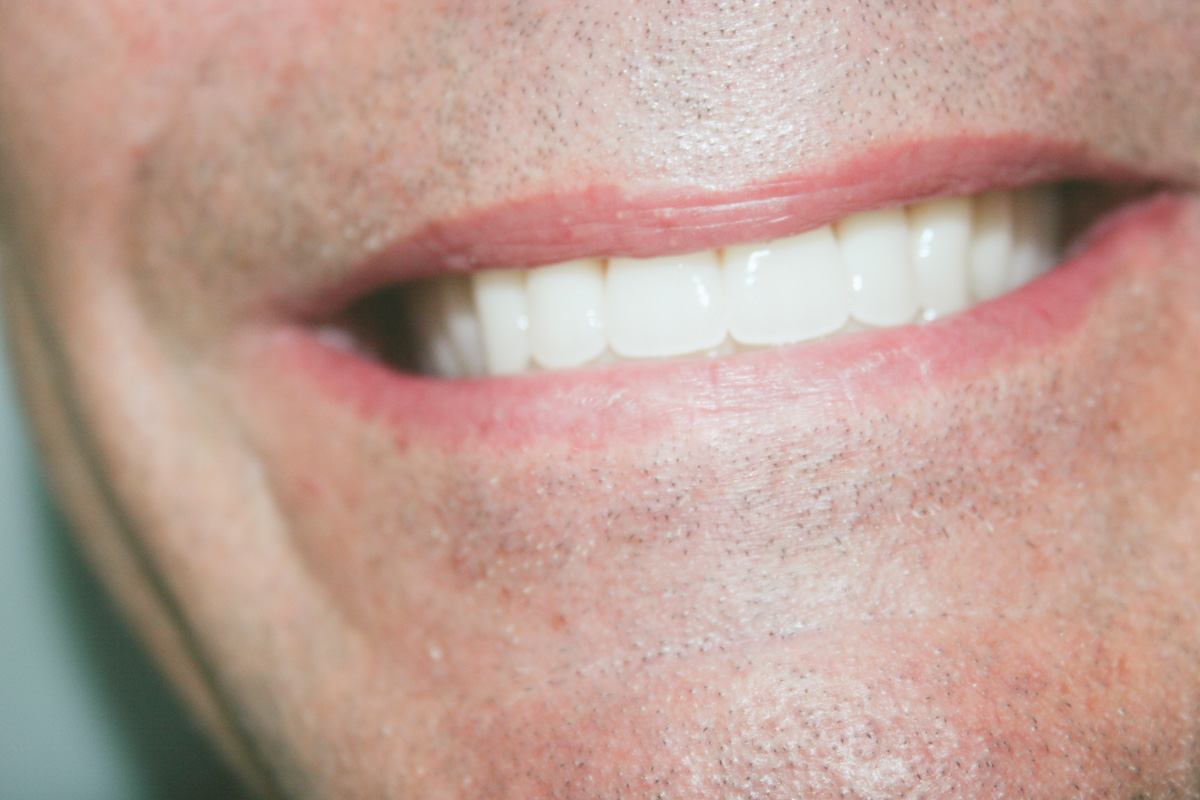 Dentaduras Totales