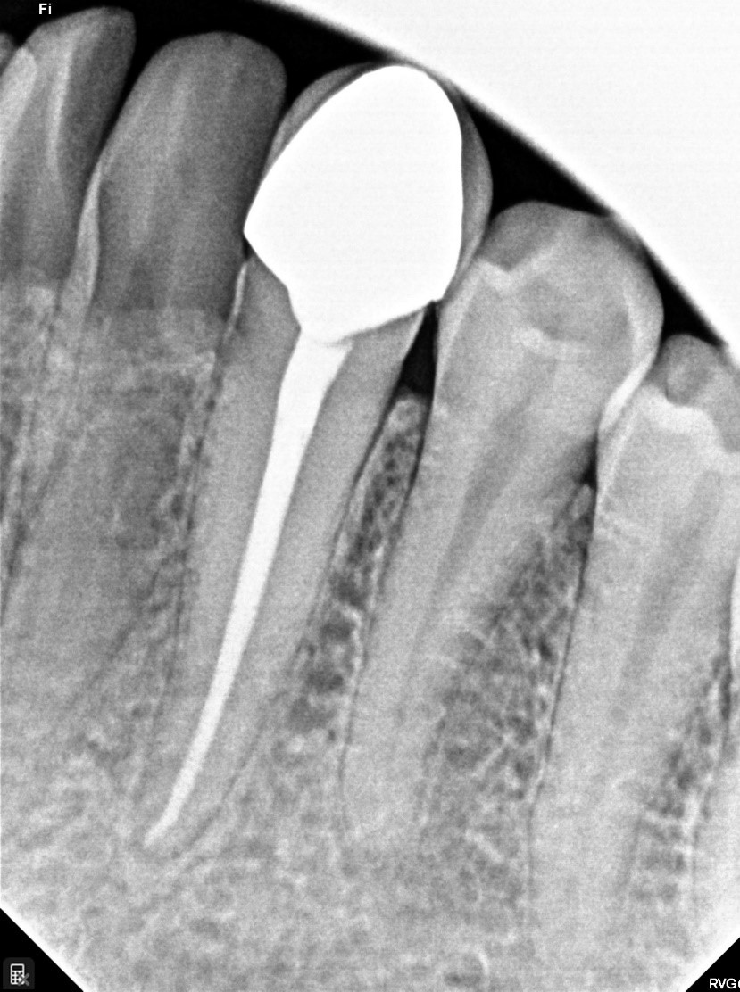 Dentaduras Totales