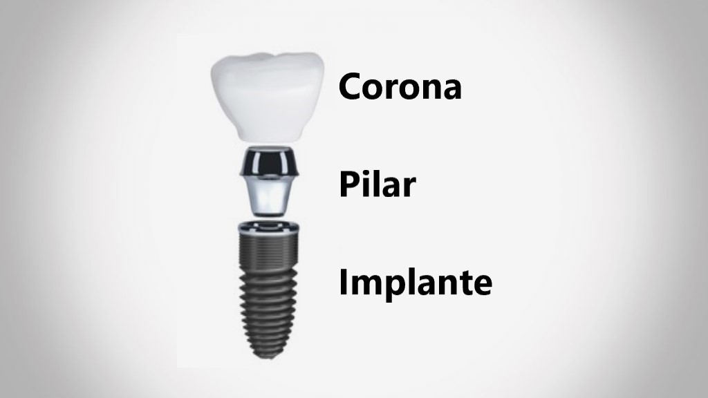 Implantes