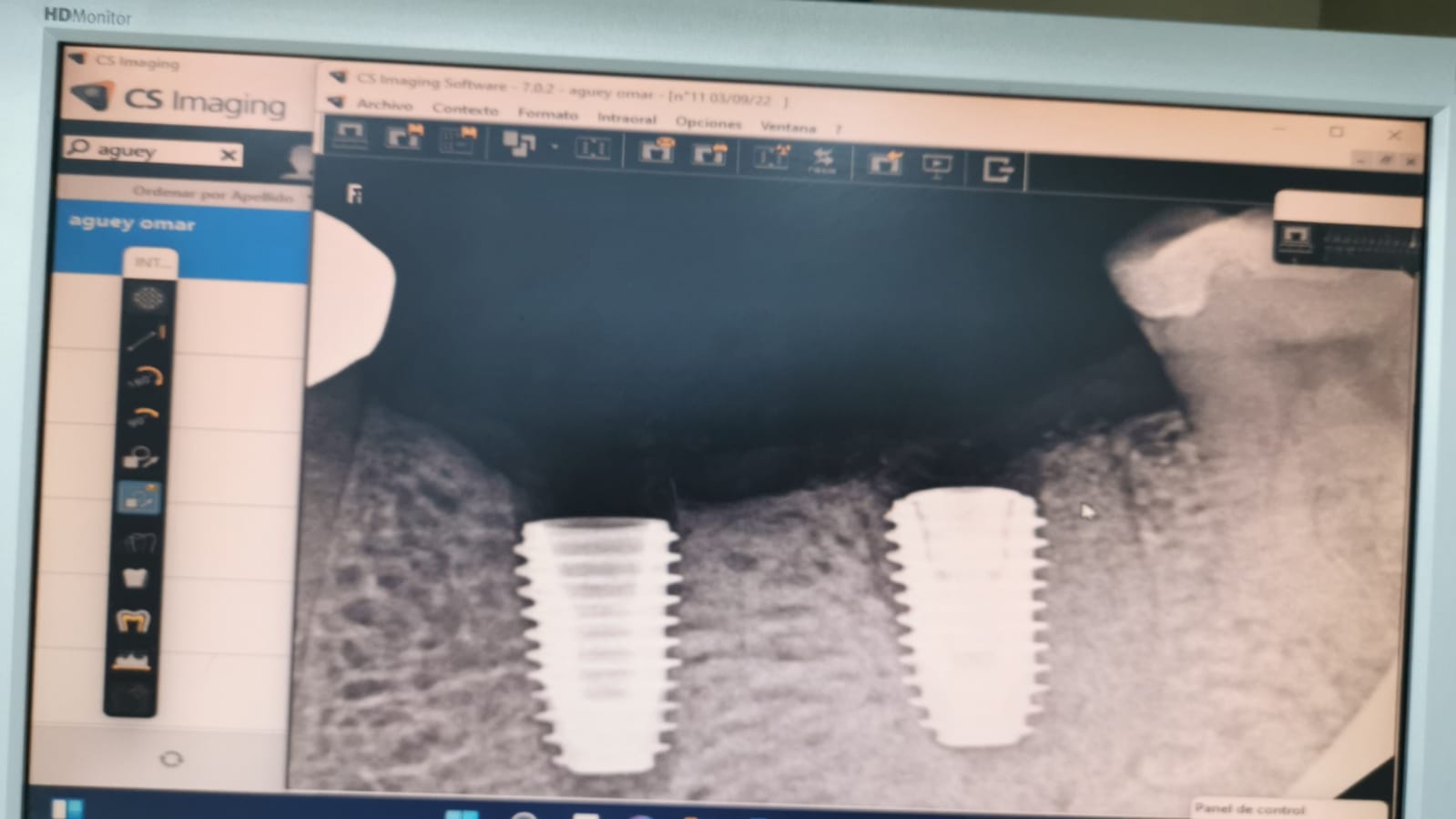 Implantes