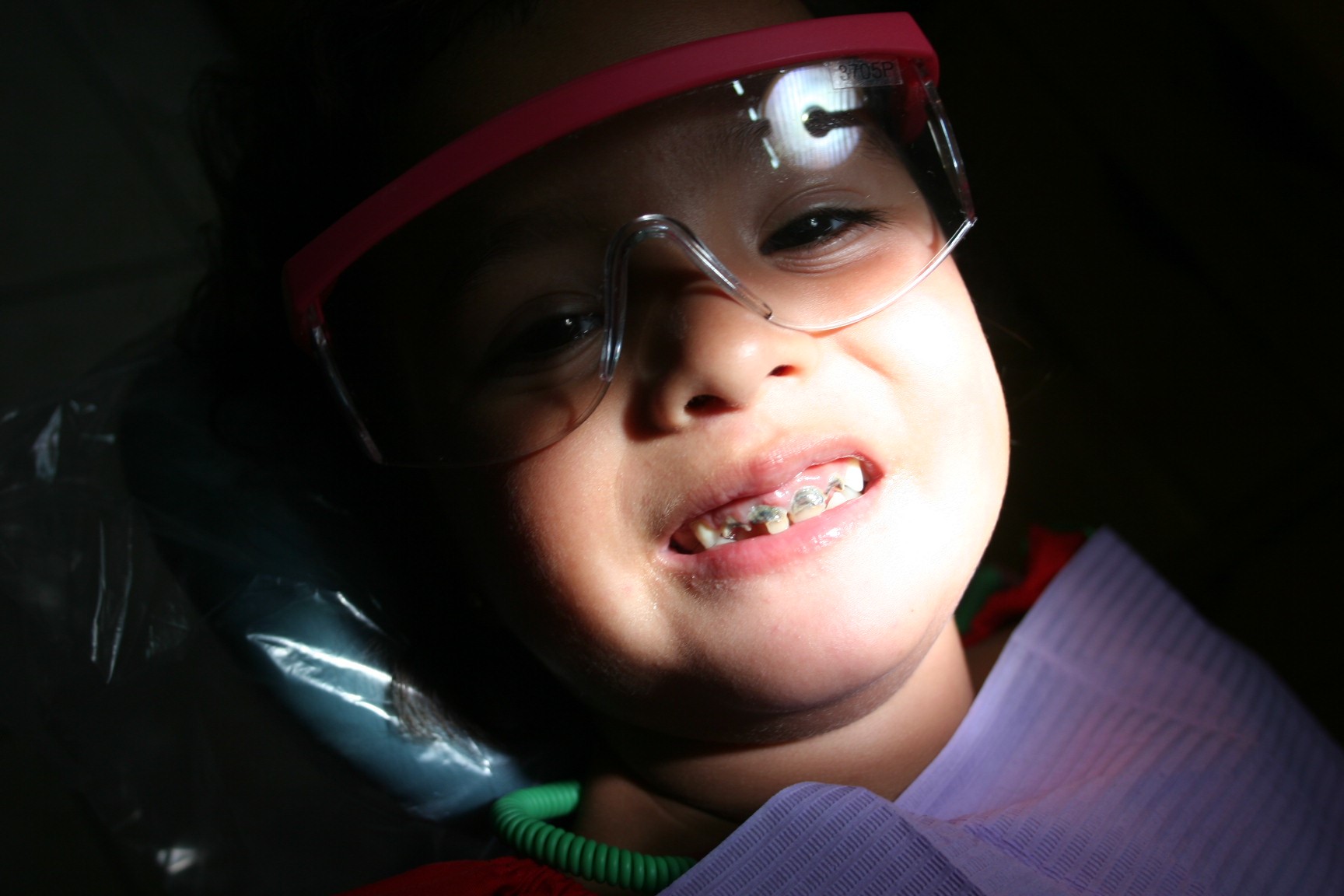 Dentaduras Totales