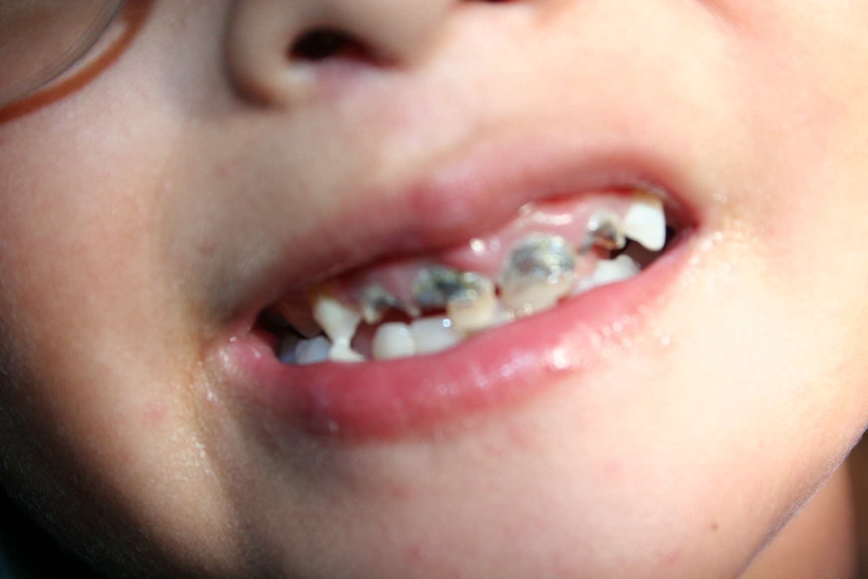 Dentaduras Totales