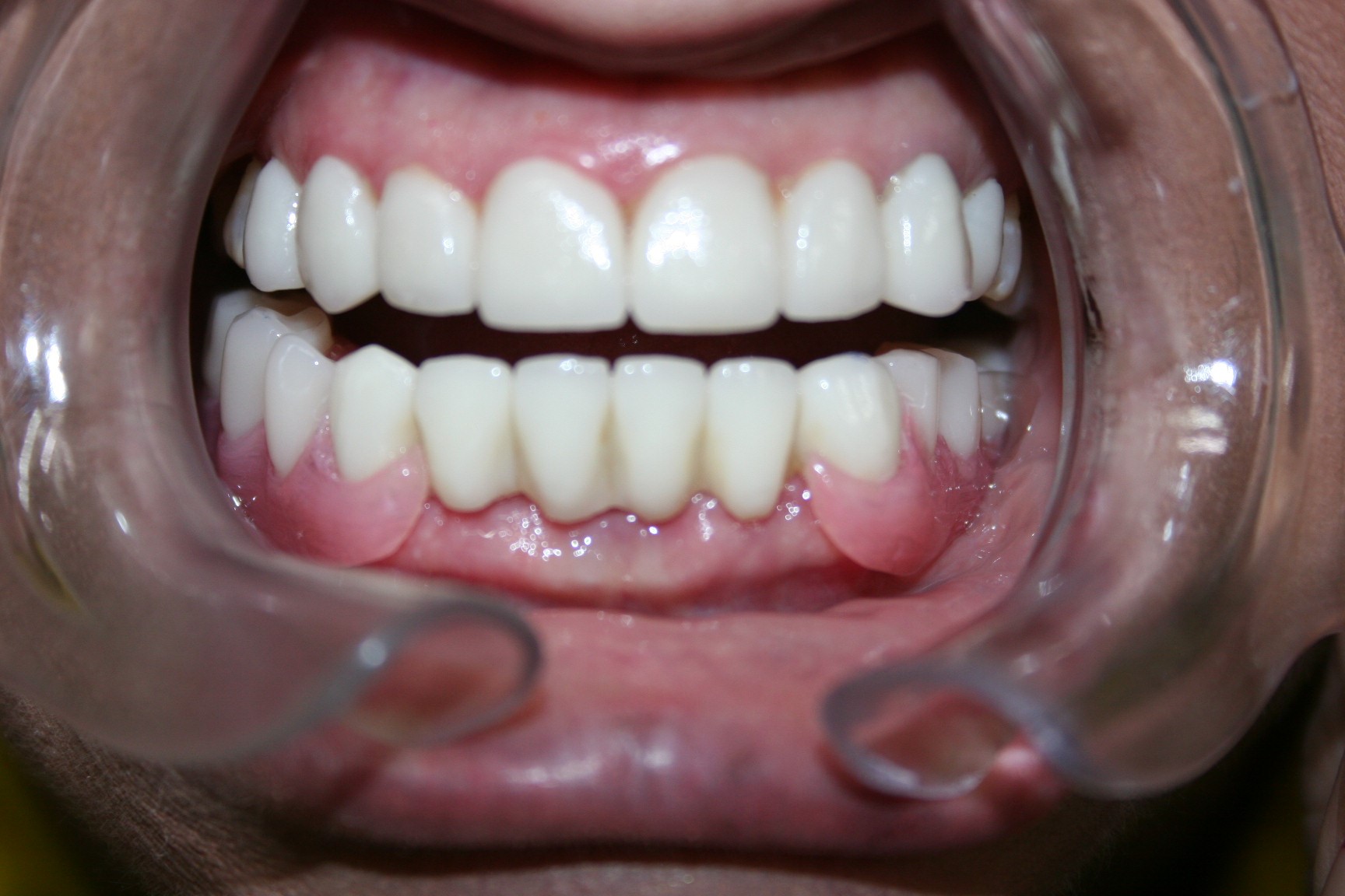 Dentaduras Totales