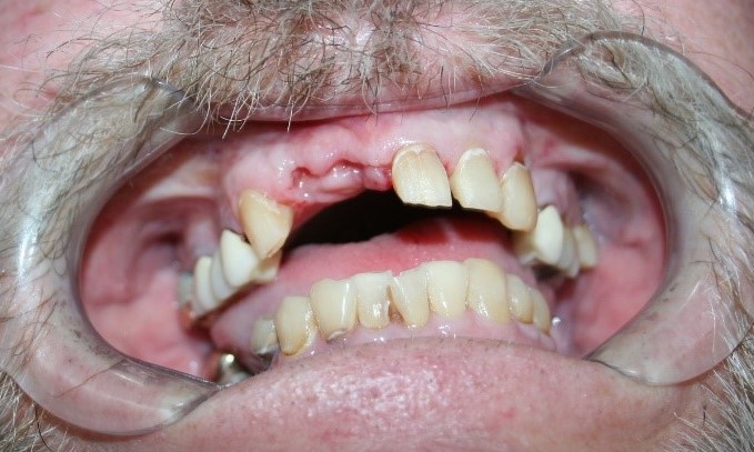 Dentaduras Totales