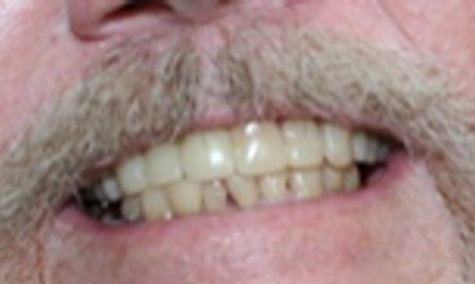 Dentaduras Totales